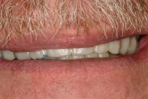 Close-up of a person's smiling mouth showing teeth, partially obscured by a mustache. Blue material visible on one tooth.