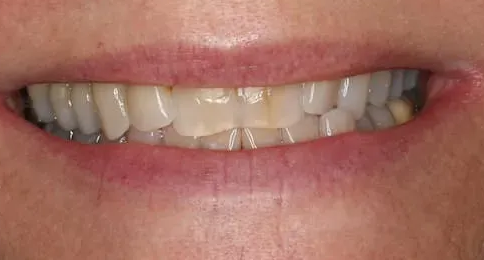 Close-up of a smiling mouth, showing uneven, yellowed teeth with slightly pink lips.