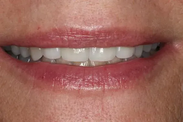Close-up of a smiling mouth, showing bright white teeth and red lips.