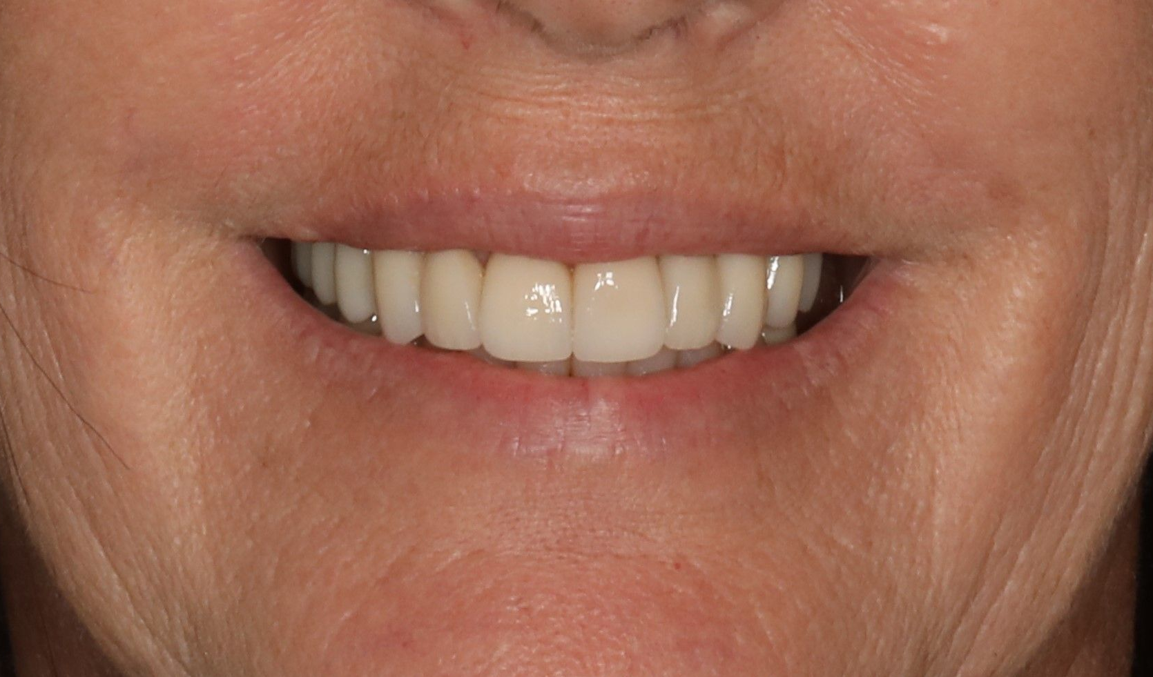 Close-up of a person smiling, showing white teeth, and pink lips. Skin is light with subtle wrinkles.
