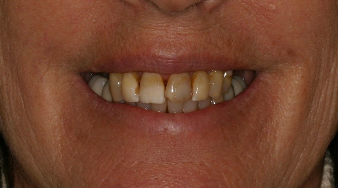 Close-up of a person's teeth, showing discoloration and gaps. Their lips are slightly parted in a smile.