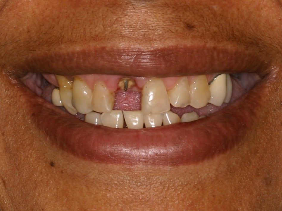 Close-up of a person's teeth, showing discoloration and gaps. Their lips are slightly parted in a smile.