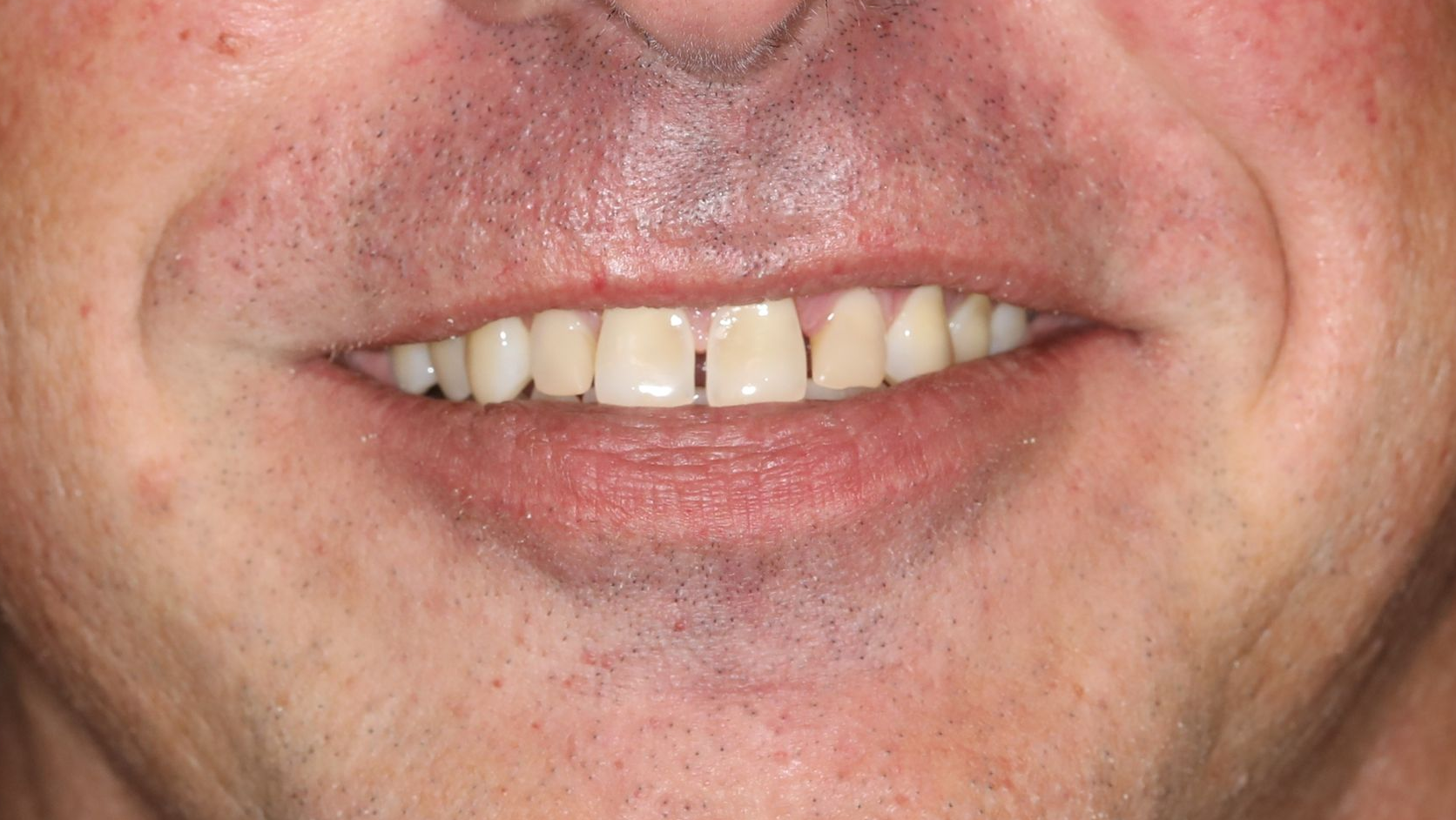Close-up of a person's teeth, showing discoloration and gaps. Their lips are slightly parted in a smile.