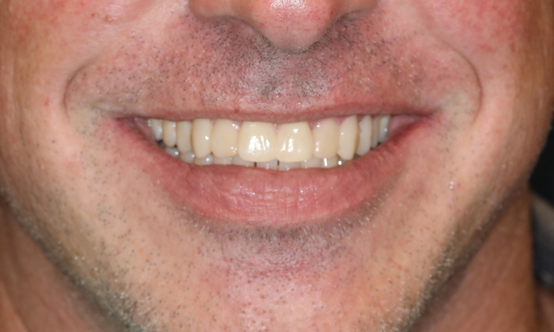 Close-up of a person smiling, showing white teeth, and pink lips. Skin is light with subtle wrinkles.