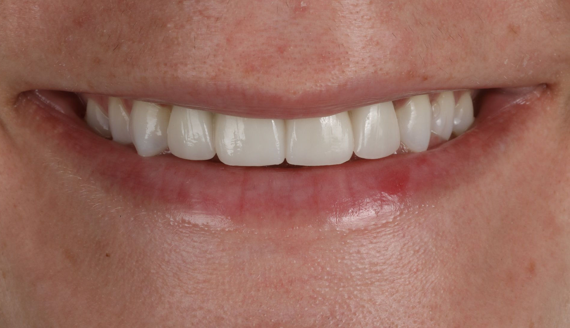 Close-up of a person's smiling mouth showing straight, white teeth and pink lips.