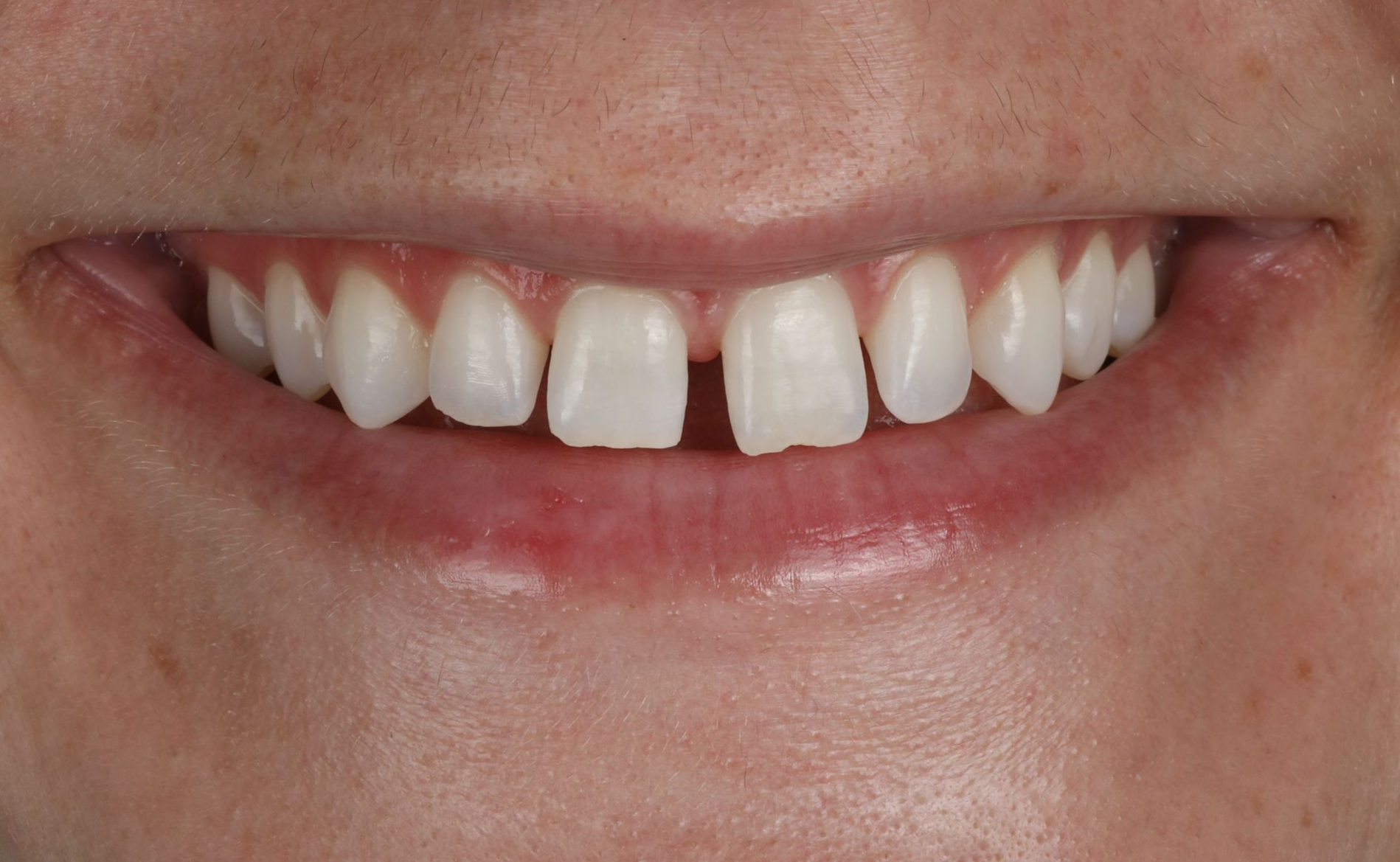 Close-up of a person's smiling mouth showing teeth with a noticeable gap between the two front teeth.
