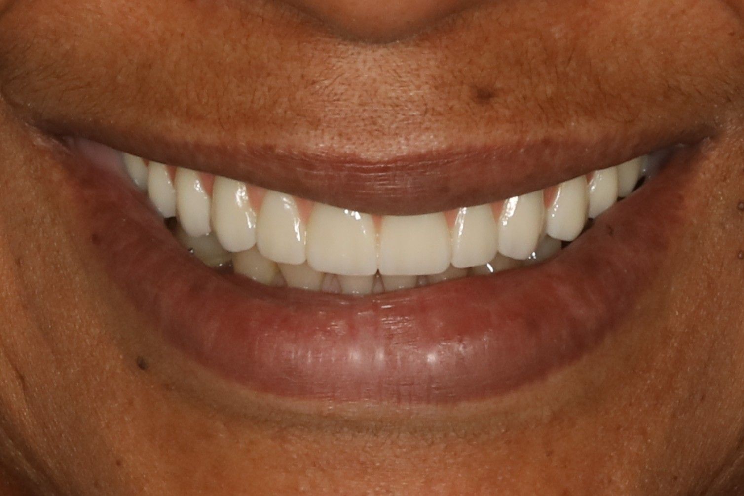 Close-up of a person smiling, showing white teeth, and pink lips. Skin is light with subtle wrinkles.