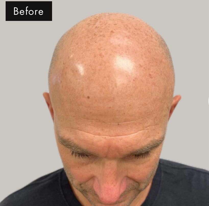 Before Scalp Micropigmentation of complete bald man