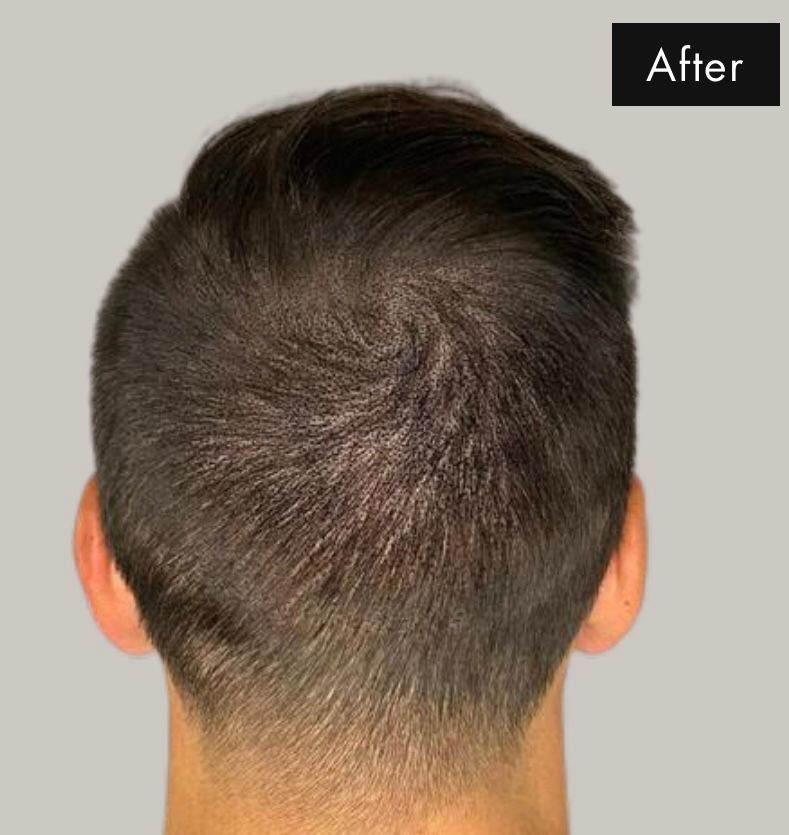 After scalp Micropigmentation Results