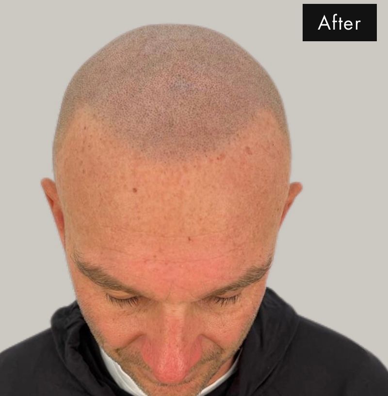 After scalp micropigmentation o f bald man now showing to have hair