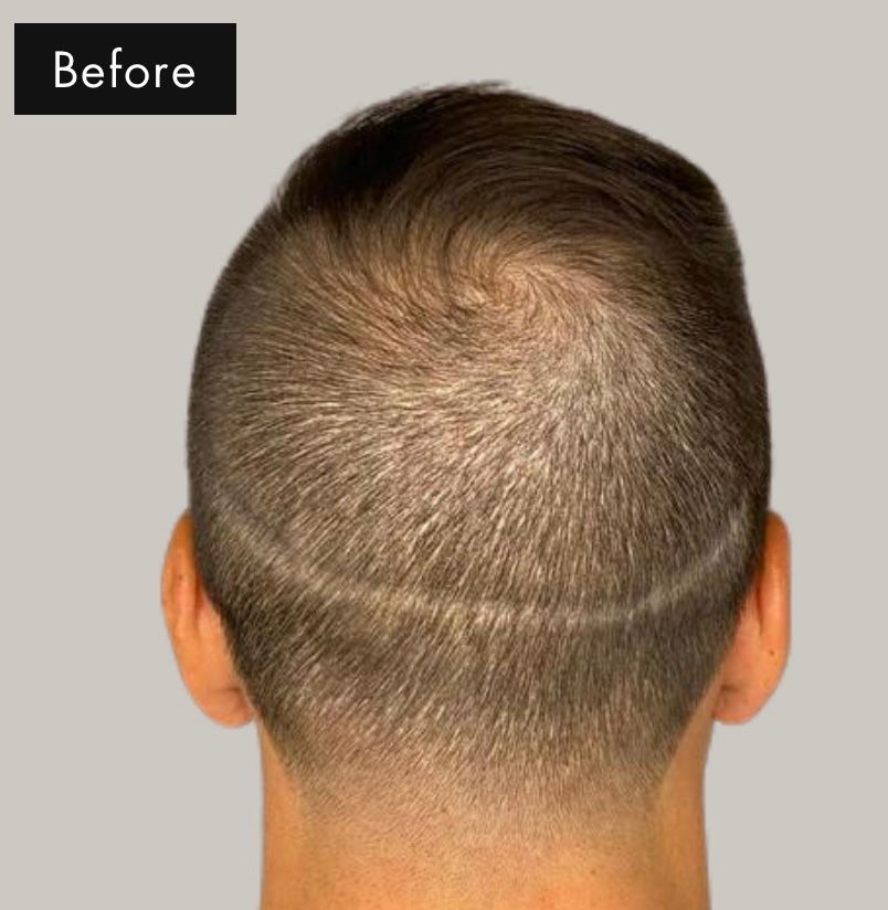 Before pic of scar from Hair transplantation