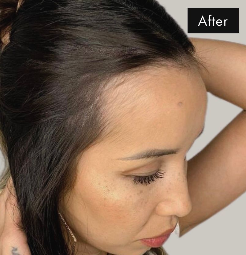 After photo of woman after receiving Scalp Micropigmentation treatment showing a dense full head of hair from a hair tattoo 