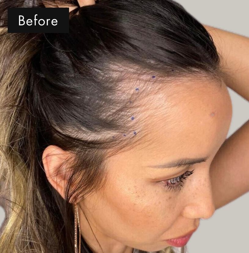 Before photo of woman with thinning hair prior to getting scalp micropigmentation or hair tattoo