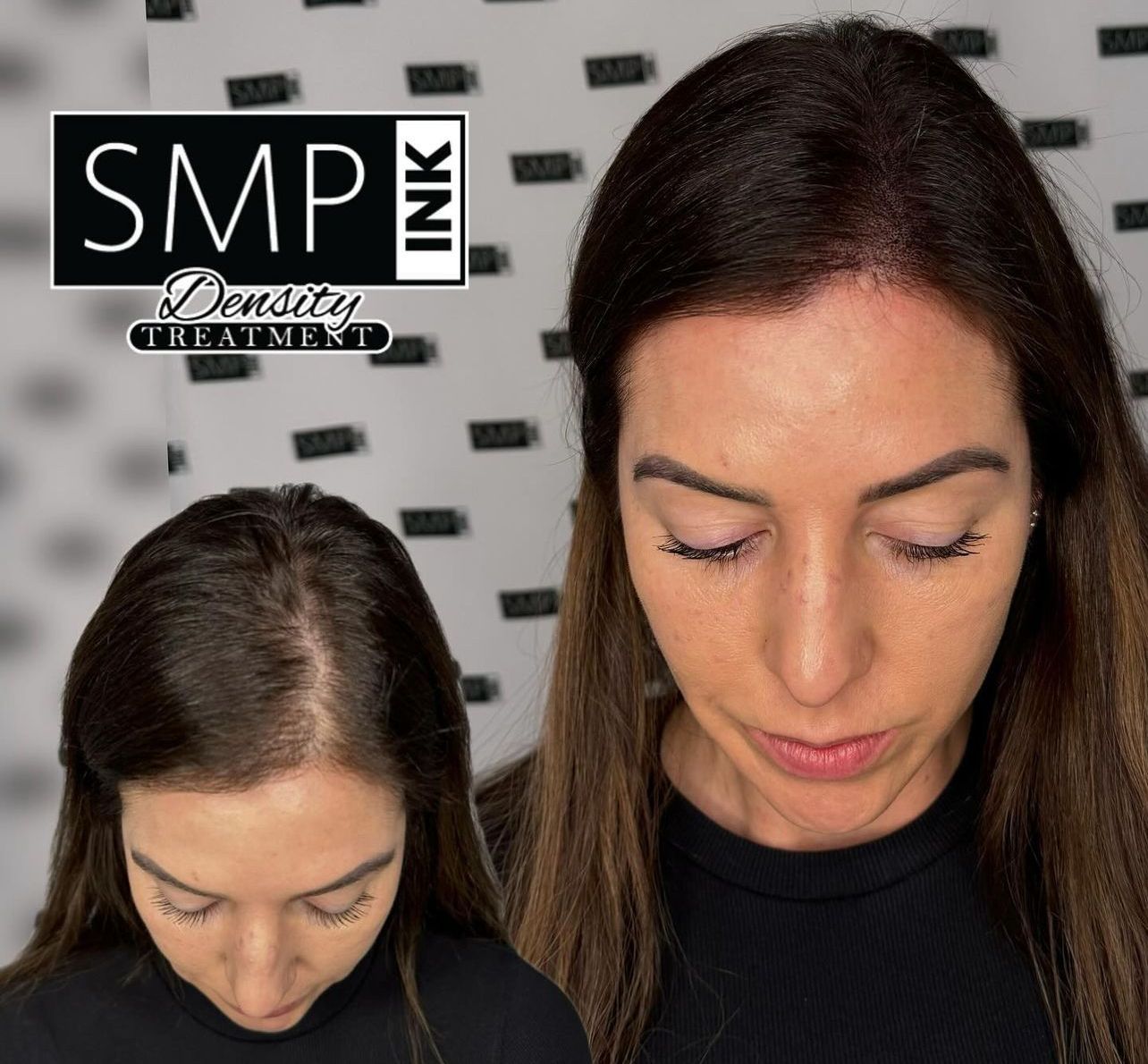 woman scalp micropigmentation or hair tattoo birmingham alabama being treated with scalp micropigmentation - hair tattoo