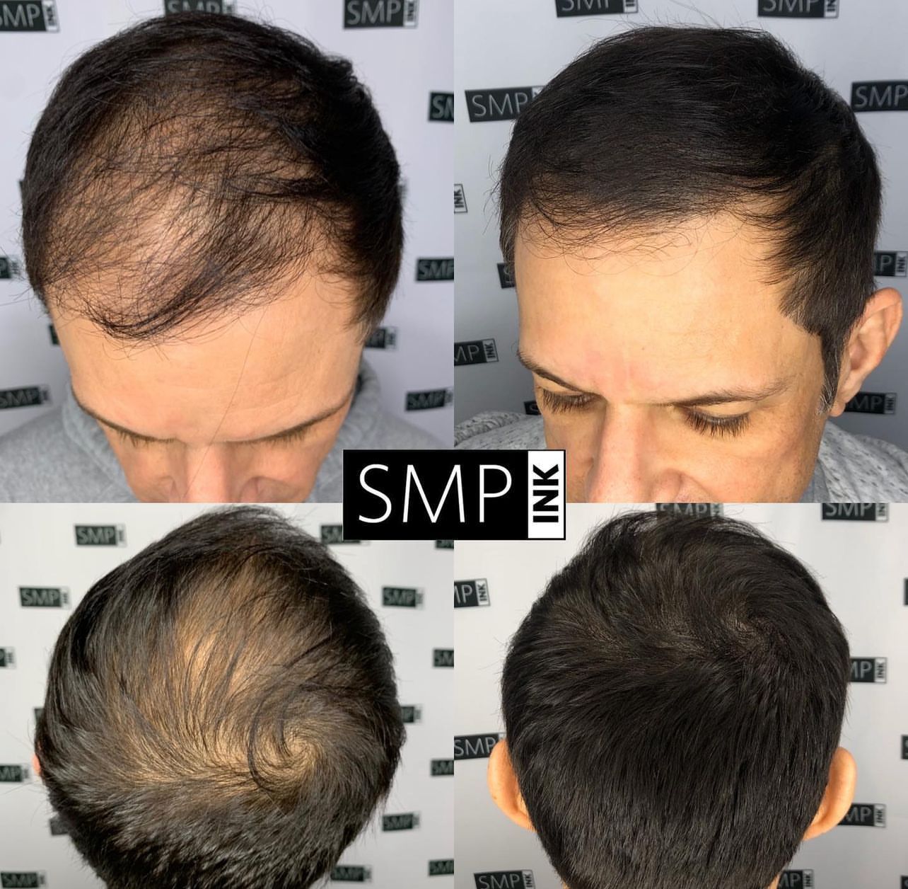 Before and after photos Mobile SMP INKED, Gulf coast , Pensacola, Florida and Alabama, Scalp Micropigmentation 