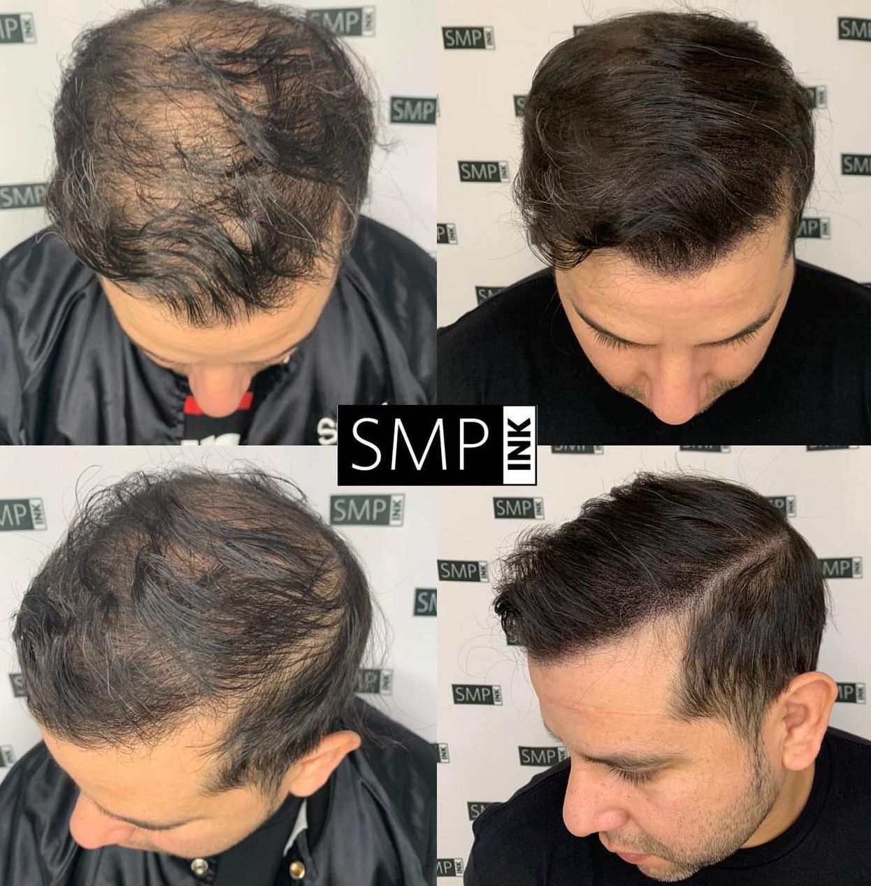 Before and after photos Mobile SMP INKED, Gulf coast , Pensacola, Florida and Alabama, Scalp Micropigmentation 