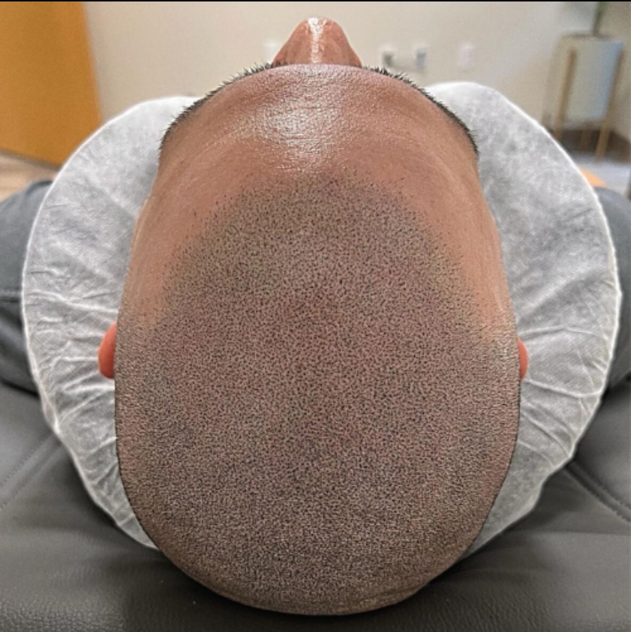 top of a clients head that just received a scalp micropigmentation treatment 