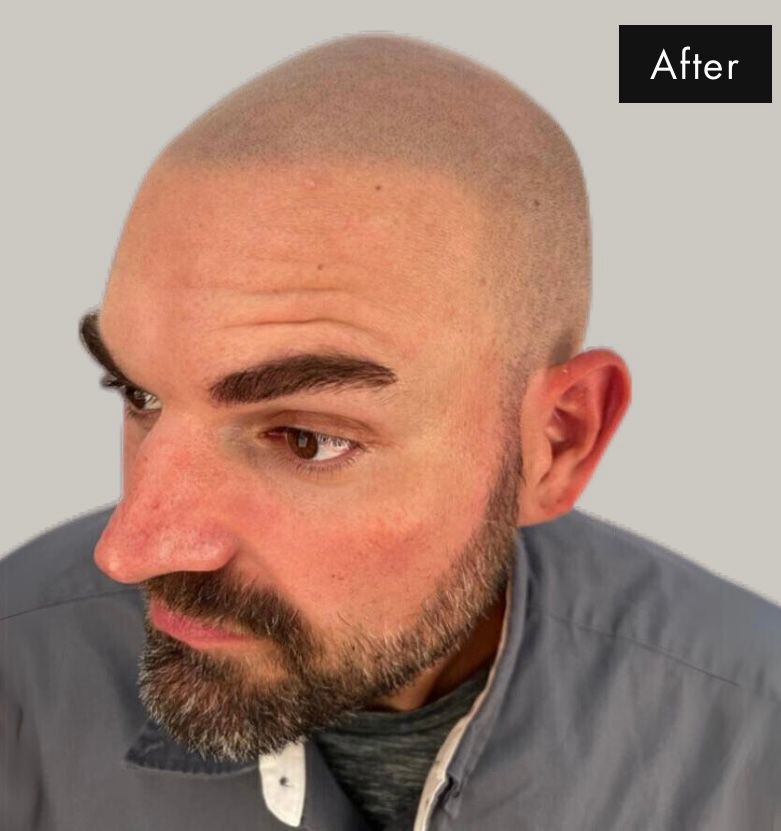 After pic of man after receiving scalp mcropigmentation treatment showing a new buzz cut look from a hair tattoo replication