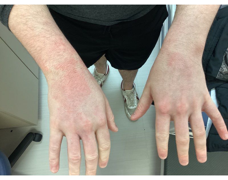 Before & After Gallery | Legacy Dermatology - Algonquin, IL
