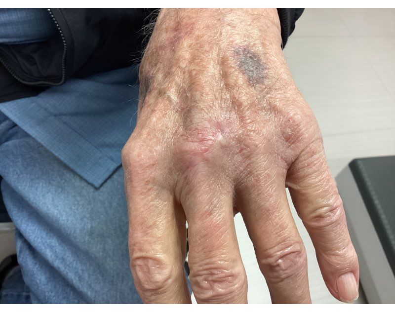 A close up of a person 's hand with a cancer spot on it