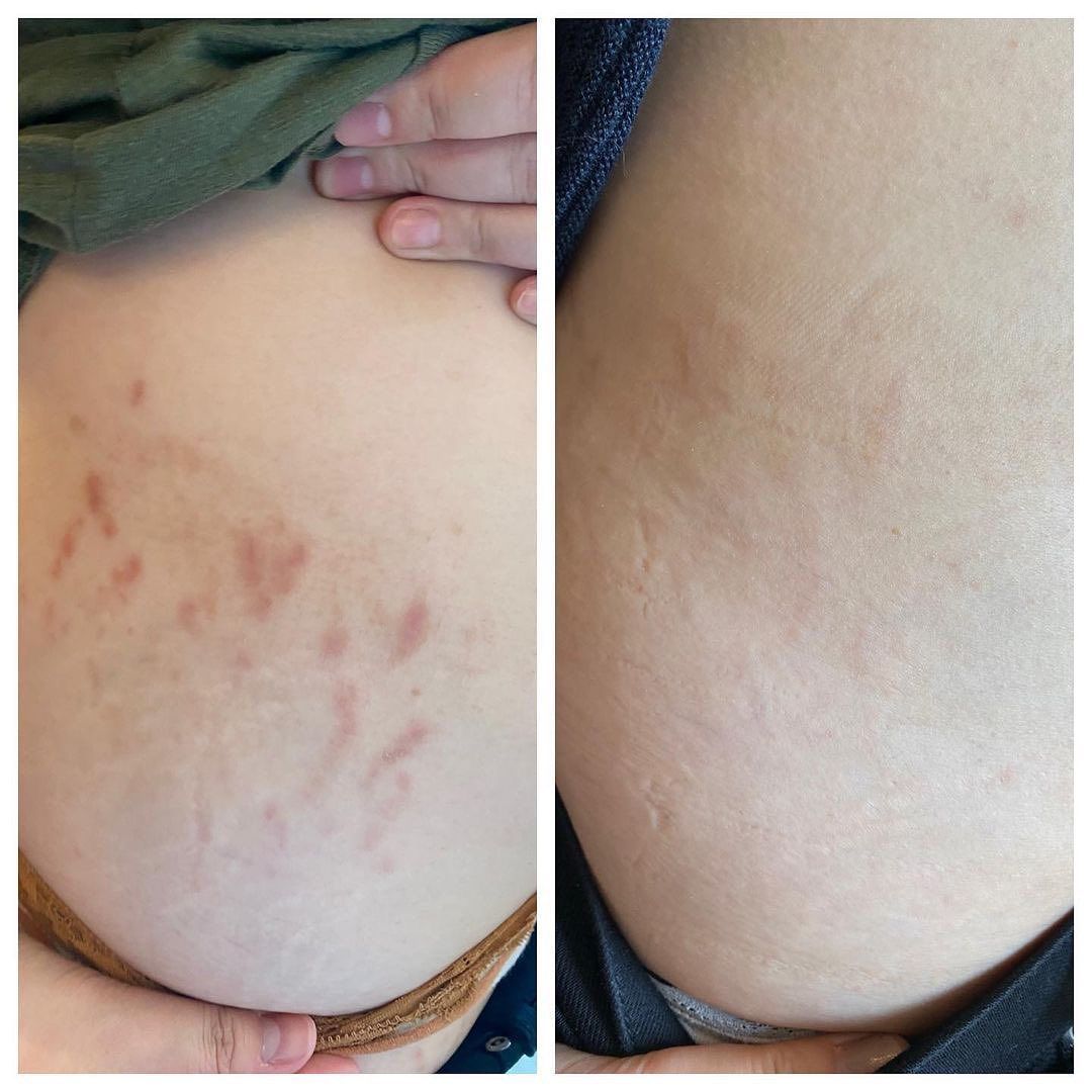 before and after aerolase neo treatment for skin rejuvenation - legacy dermatology