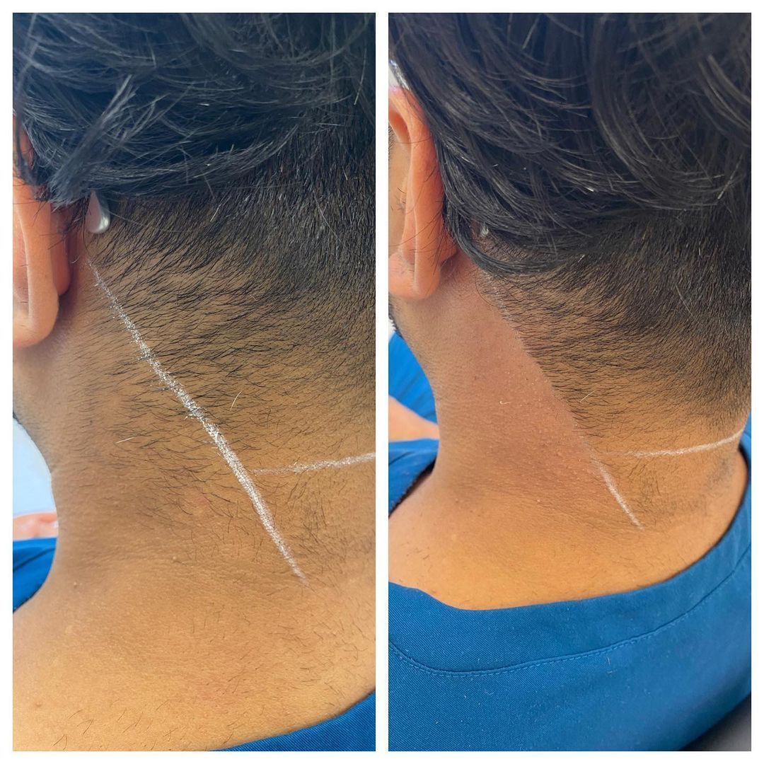 before and after aerolase neo treatment for skin rejuvenation - legacy dermatology