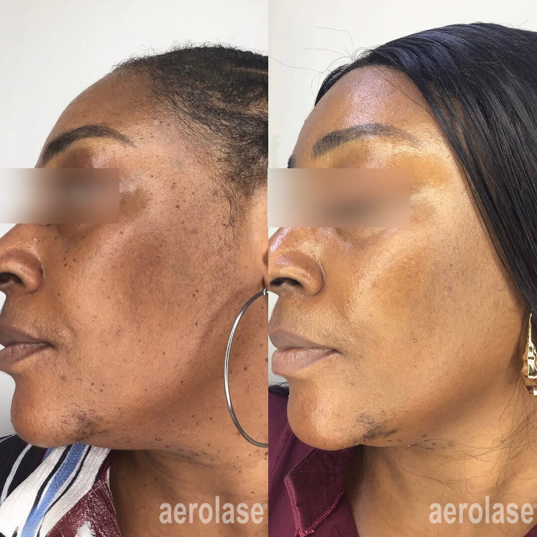before and after aerolase neo treatment for skin rejuvenation - legacy dermatology