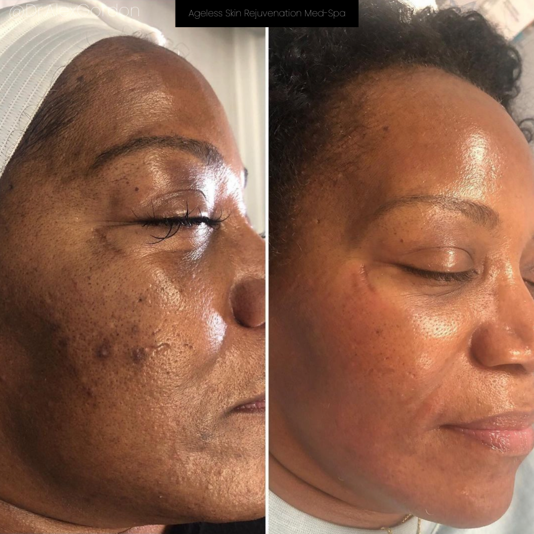 before and after aerolase neo treatment for skin rejuvenation - legacy dermatology