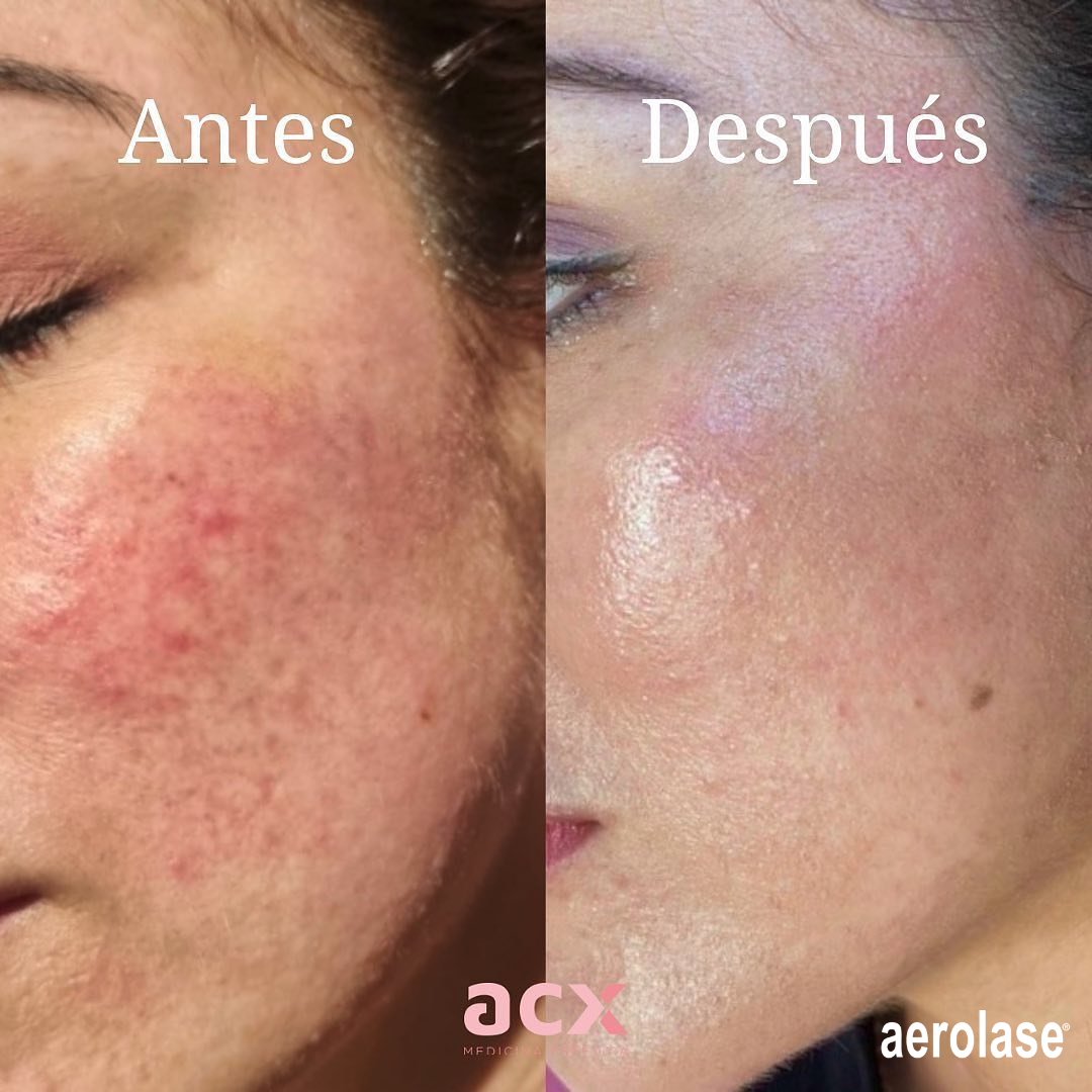 before and after aerolase neo treatment for skin rejuvenation - legacy dermatology