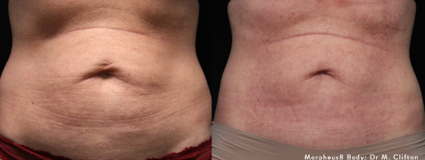 before and after morpheus8 for abdomen