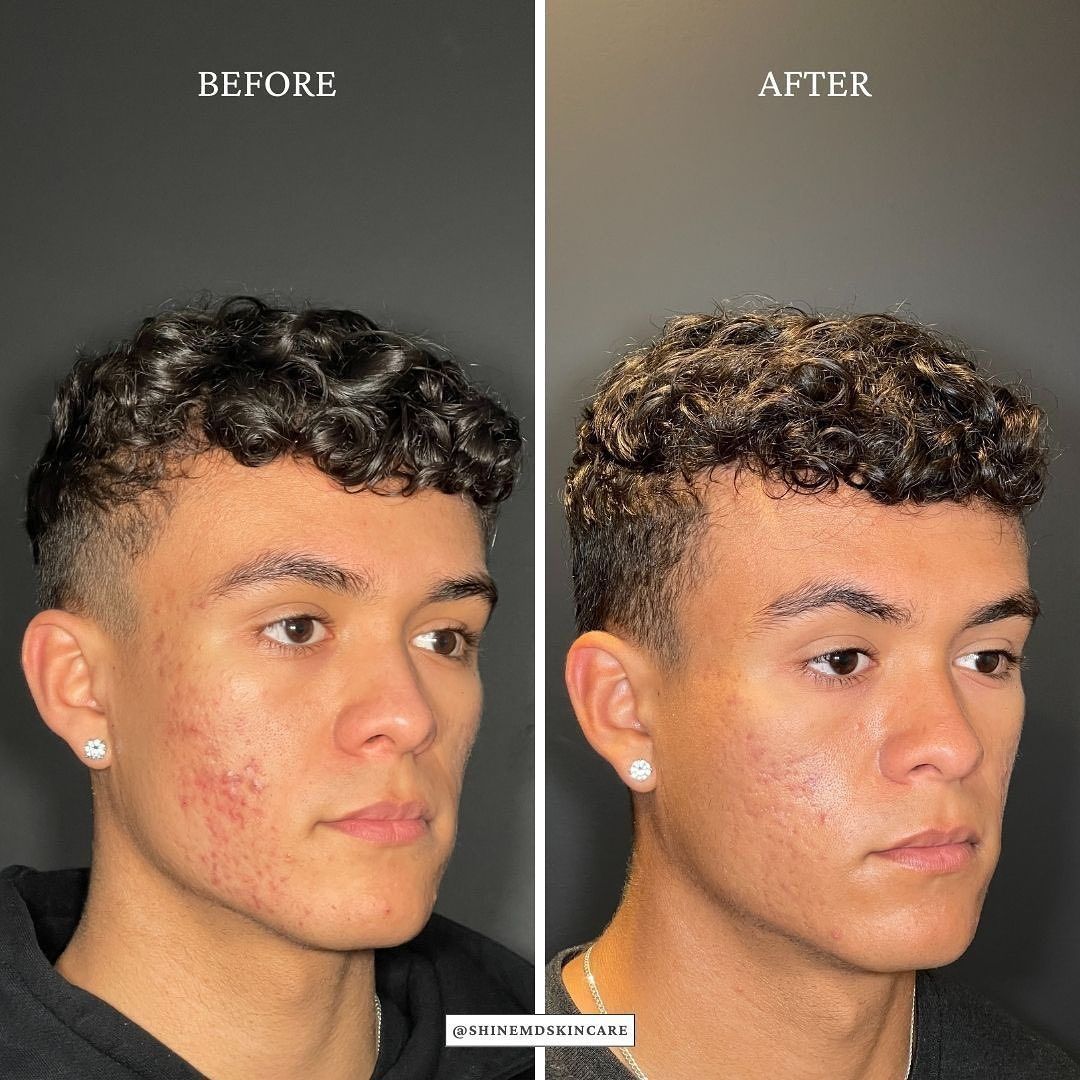before and after aerolase neo treatment for skin rejuvenation - legacy dermatology