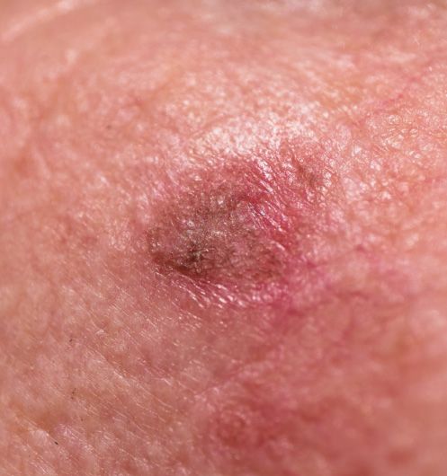 closeup of actinic keratosis on cheek