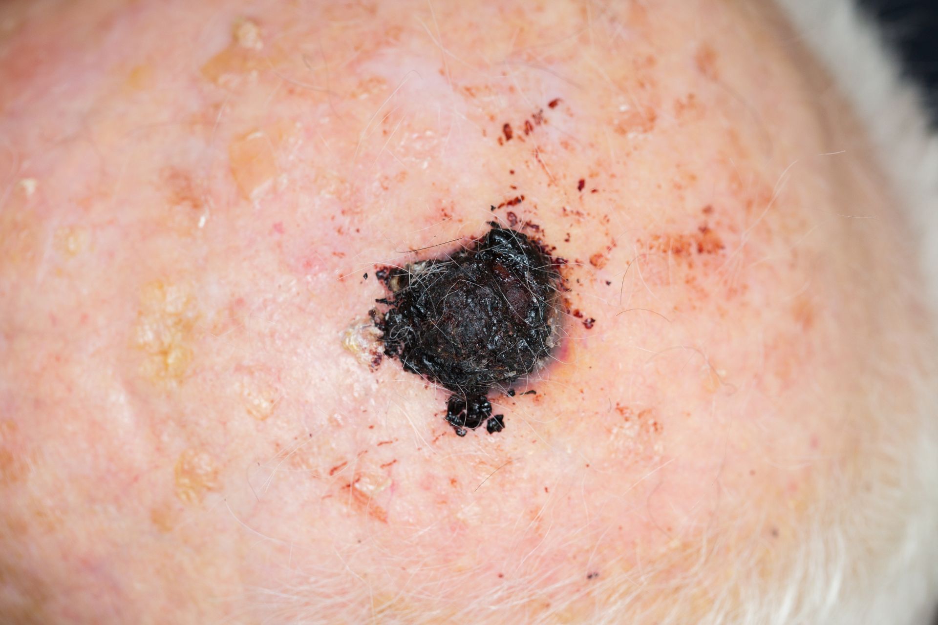 advanced melanoma spot on elderly white male scalp