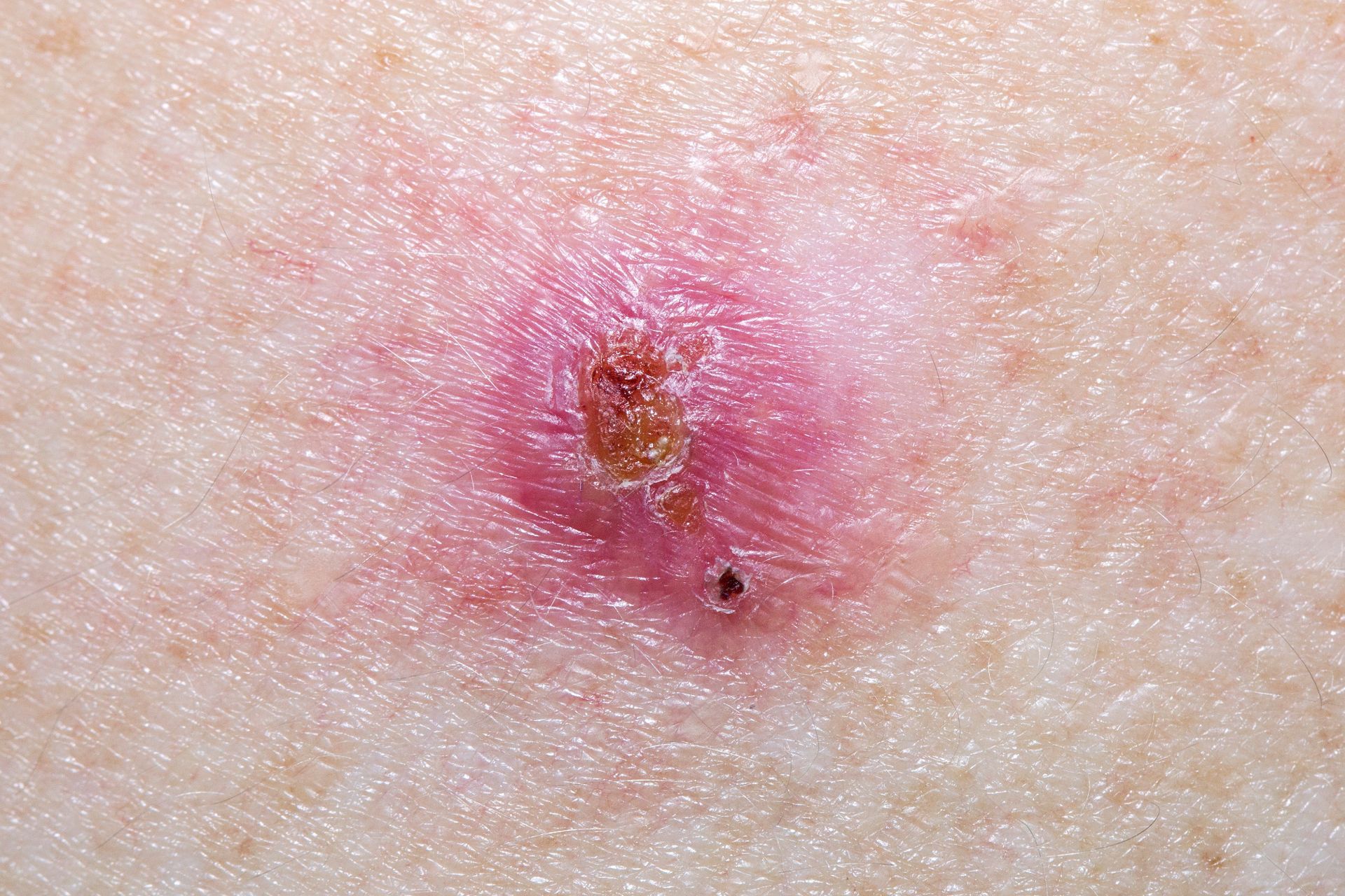 inflamed basal cell carcinoma spot on white patient's skin