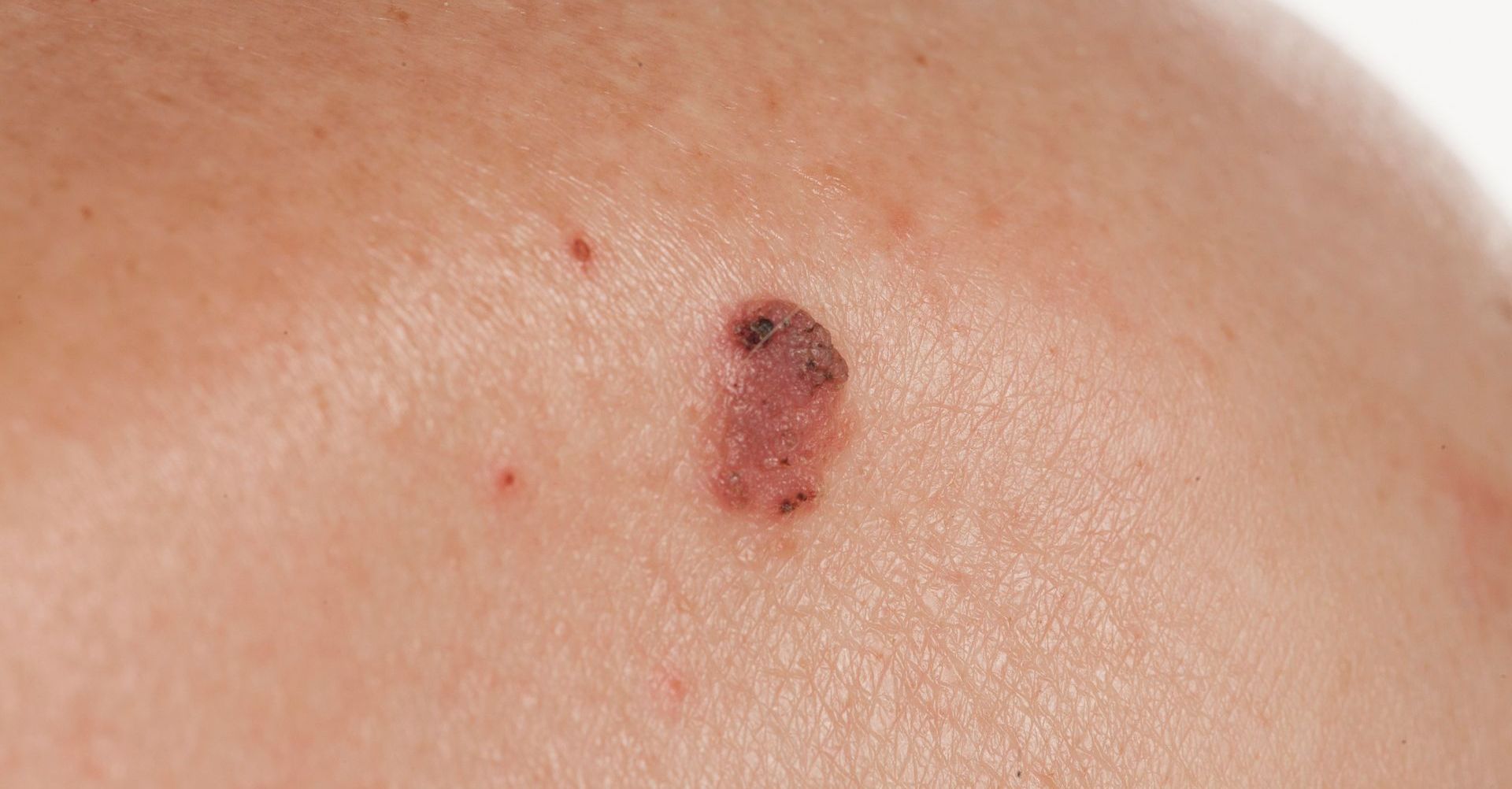 squamous cell cancer on white patient' skin