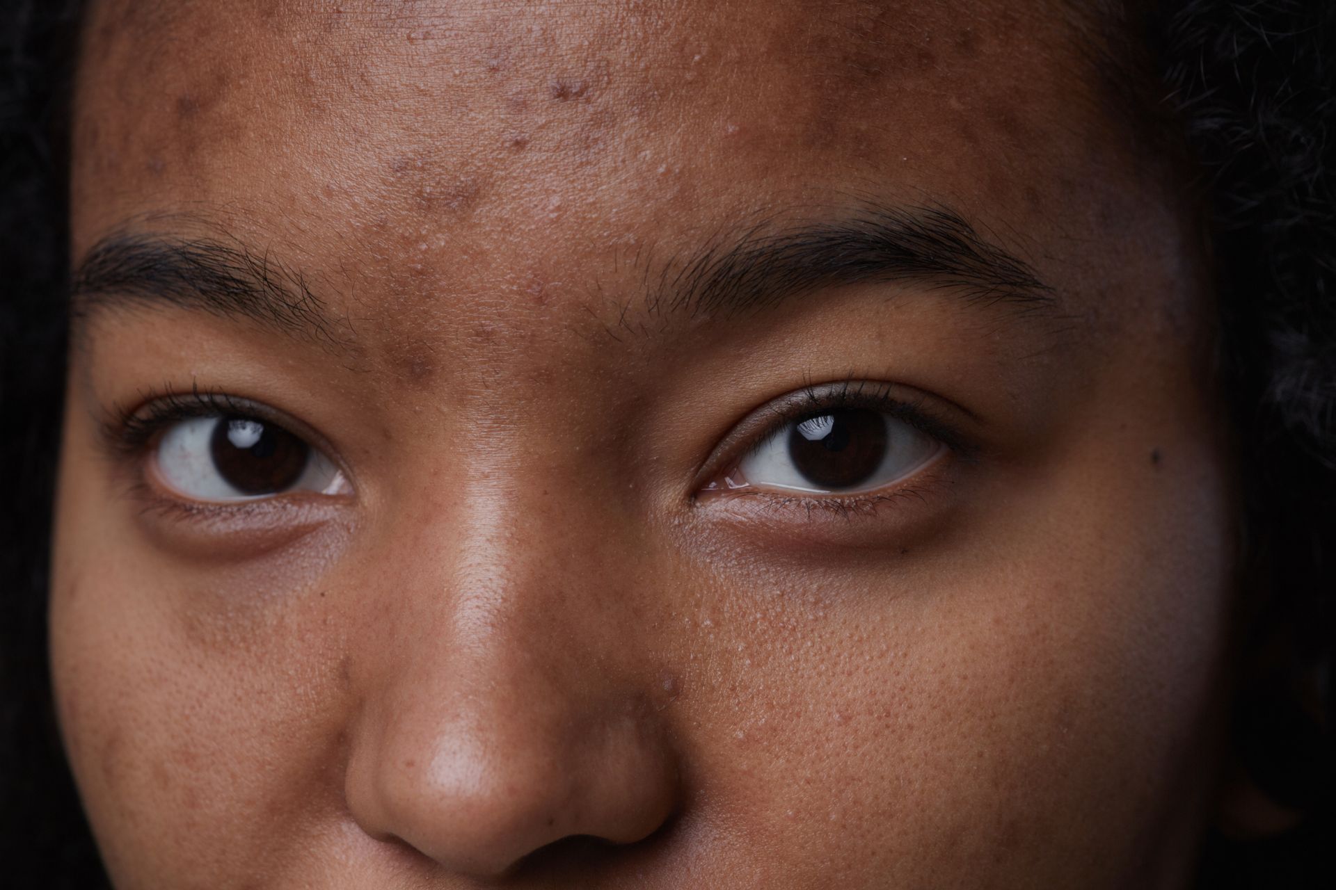 A close up of a woman 's face with acne on it.