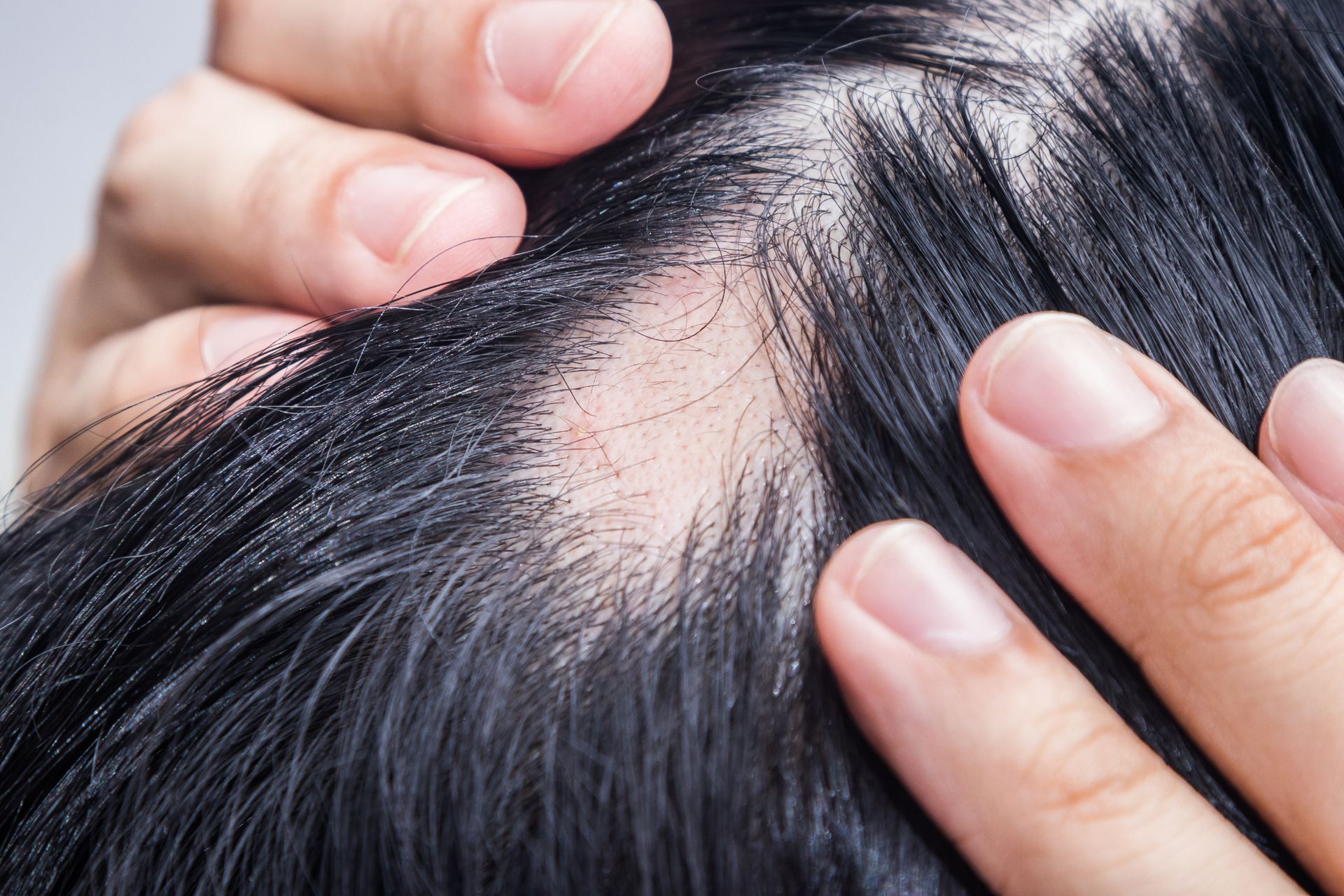 bald spot on patient's scalp caused by alopecia