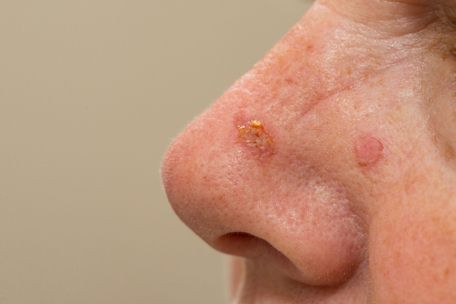 healing cryotherapy wound on nose