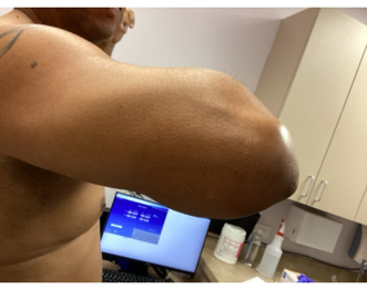 A person's bare upper arm and elbow shown from a side perspective in a medical or office setting.