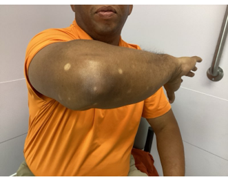 A person in an orange shirt holds their arm out, showing several circular, light-colored spots on their skin.
