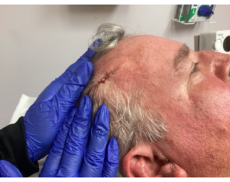 Gloved hands gently hold the skin near a fresh surgical incision on a person's scalp in a clinical setting.