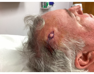 A close-up of a person's temple showing a small, pale growth outlined in purple ink, likely prepared for a procedure.