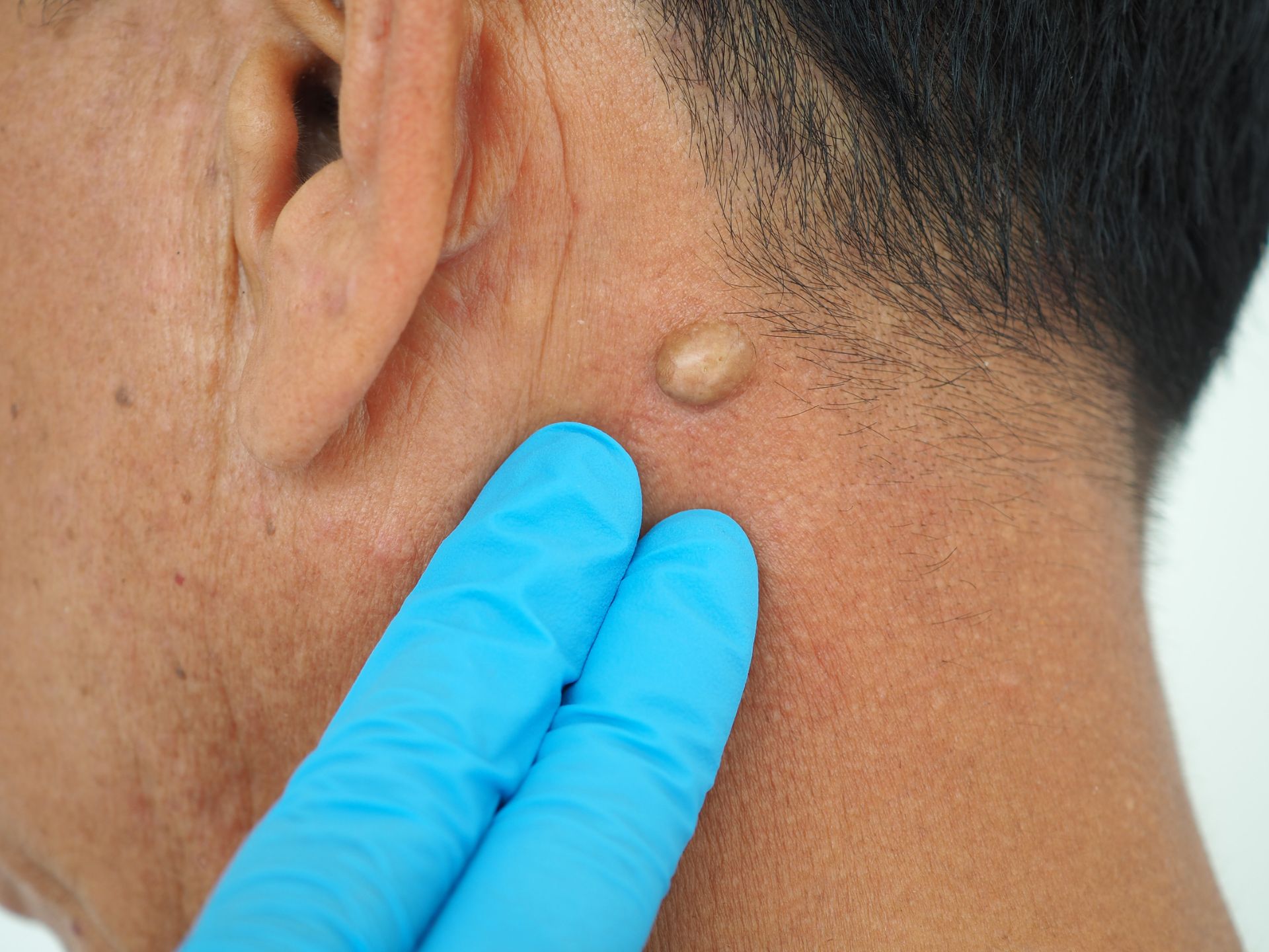 closeup of epidermal cyst behind ear