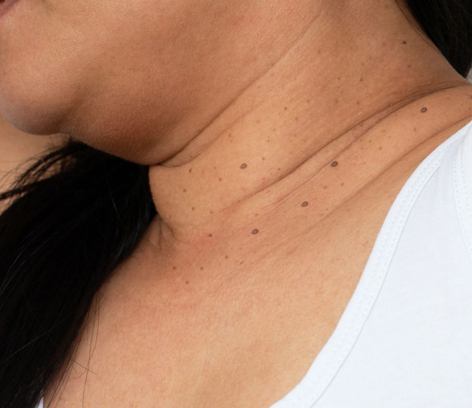 dermatosis papulosa nigra on black womans