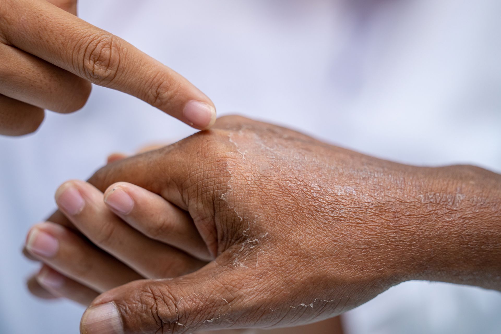 dermatologist points at eczema on black male patient's hand
