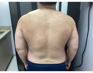 A view of a person’s upper back and shoulders, showing skin with scattered, pale, slightly raised, linear marks.