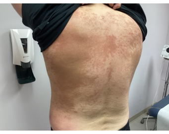 A person’s back showing a widespread, reddish-brown, reticulated skin rash in a clinical setting.