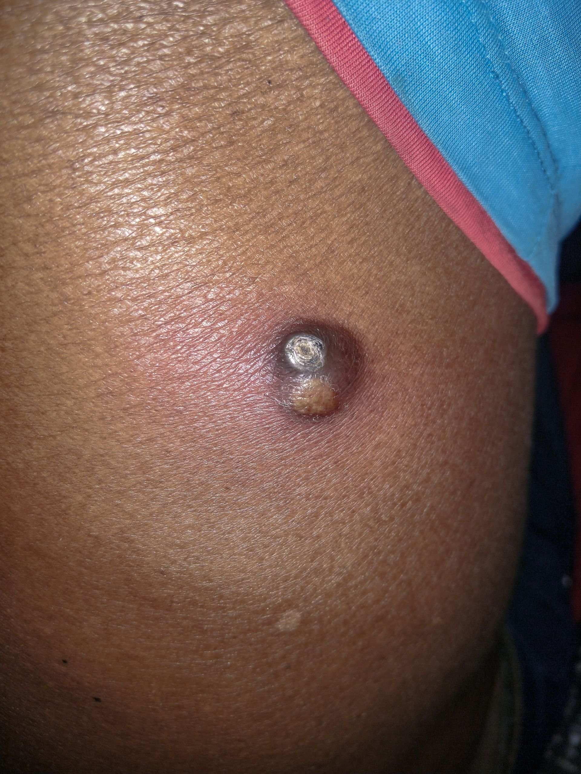 enlarged abscess on black male patient's stomach