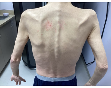 A bare-chested person viewed from the back, showing prominent shoulder blades and spinal definition.