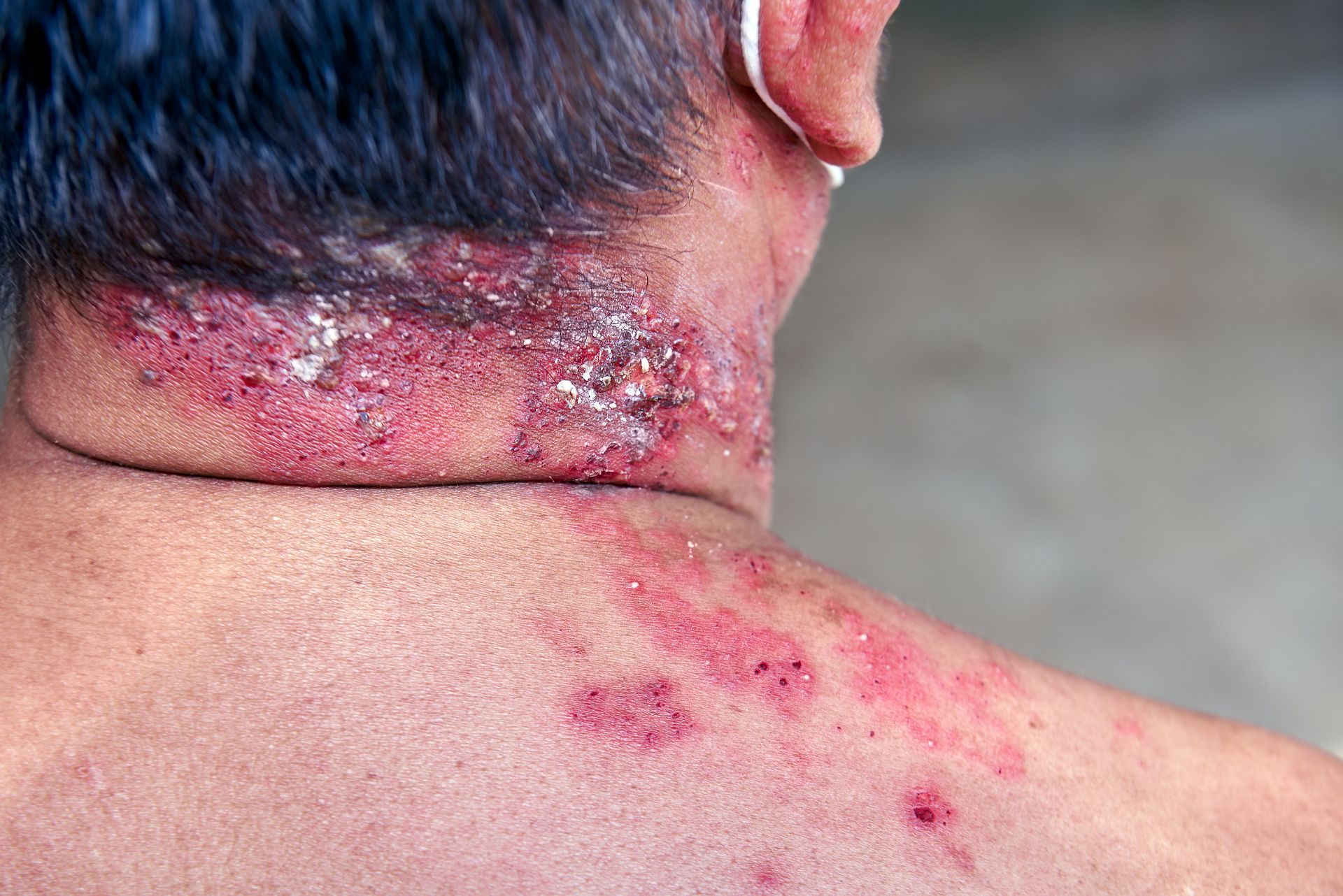 advanced shingles breakout on male patient's neck and back